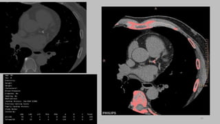 Ct   coronary  angiography edited 1st