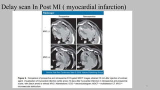 Ct   coronary  angiography edited 1st