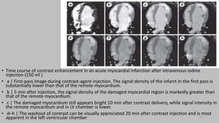 Ct   coronary  angiography edited 1st