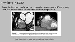 Ct   coronary  angiography edited 1st