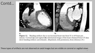 Ct   coronary  angiography edited 1st
