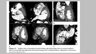 Ct   coronary  angiography edited 1st