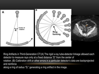 Ring Artifacts in Third-Generation CT:(A) The rigid x-ray tube-detector linkage allowed each
detector to measure rays only at a fixed distance “D” from the center of
rotation. (B) Calibration drift or other errors in a particular detector’s data are backprojected
and reinforce
along a ring of radius “D,” generating a ring artifact in the image.
 
