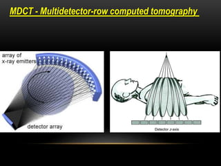 MDCT - Multidetector-row computed tomography
 