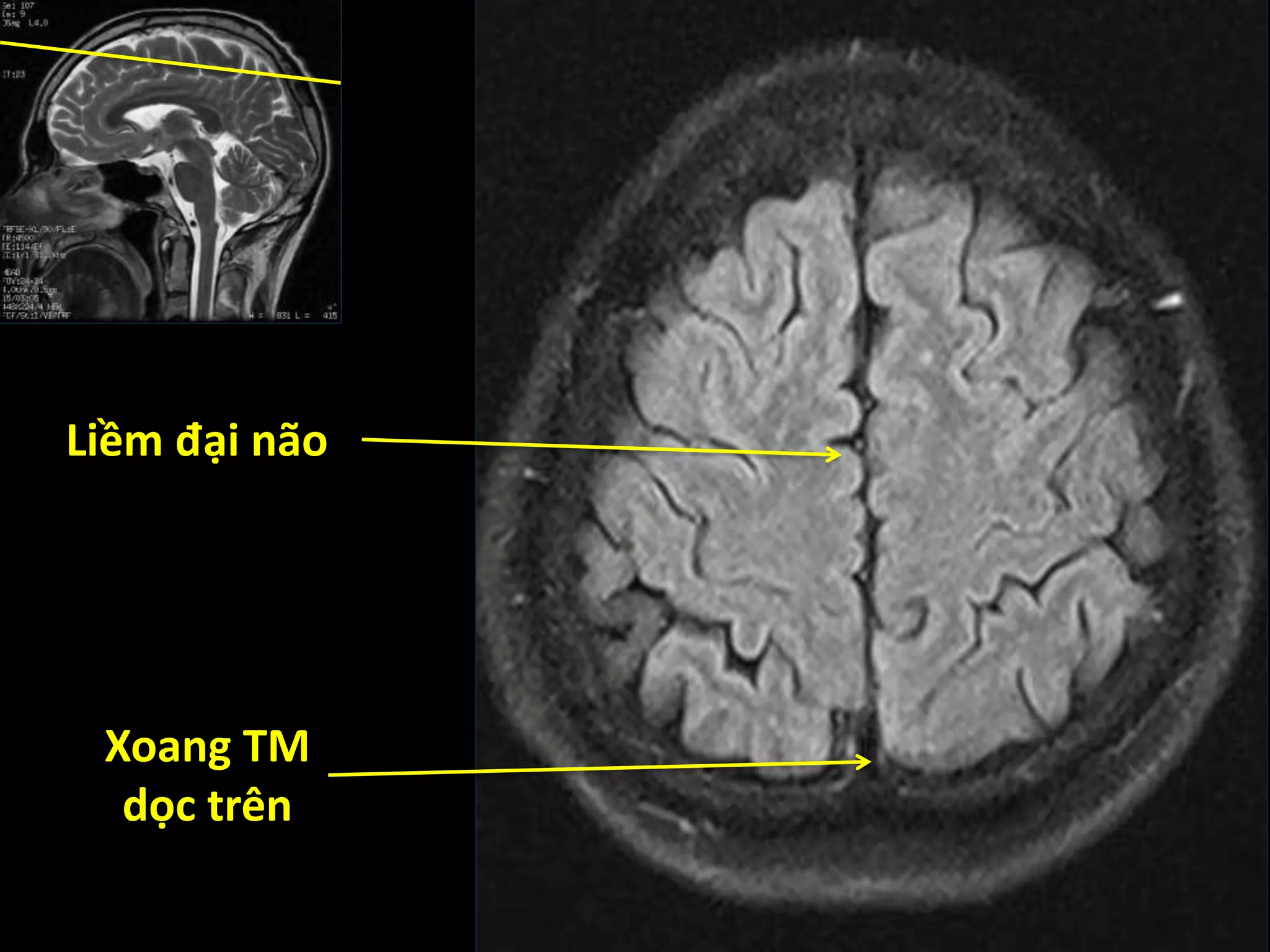 Liềm đại não
Xoang TM
dọc trên
 