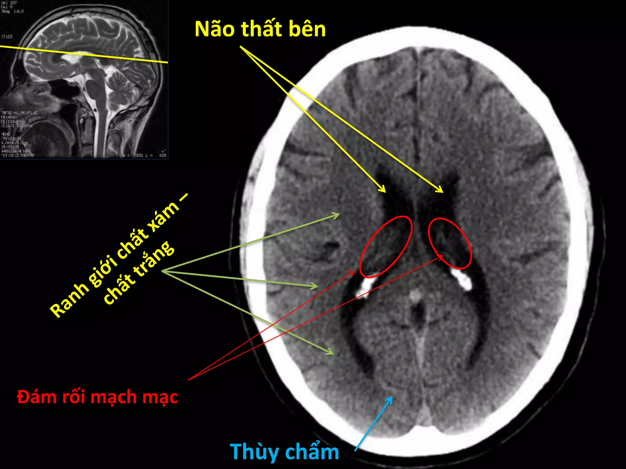 Não thất bên
Thùy chẩm
Đám rối mạch mạc
 
