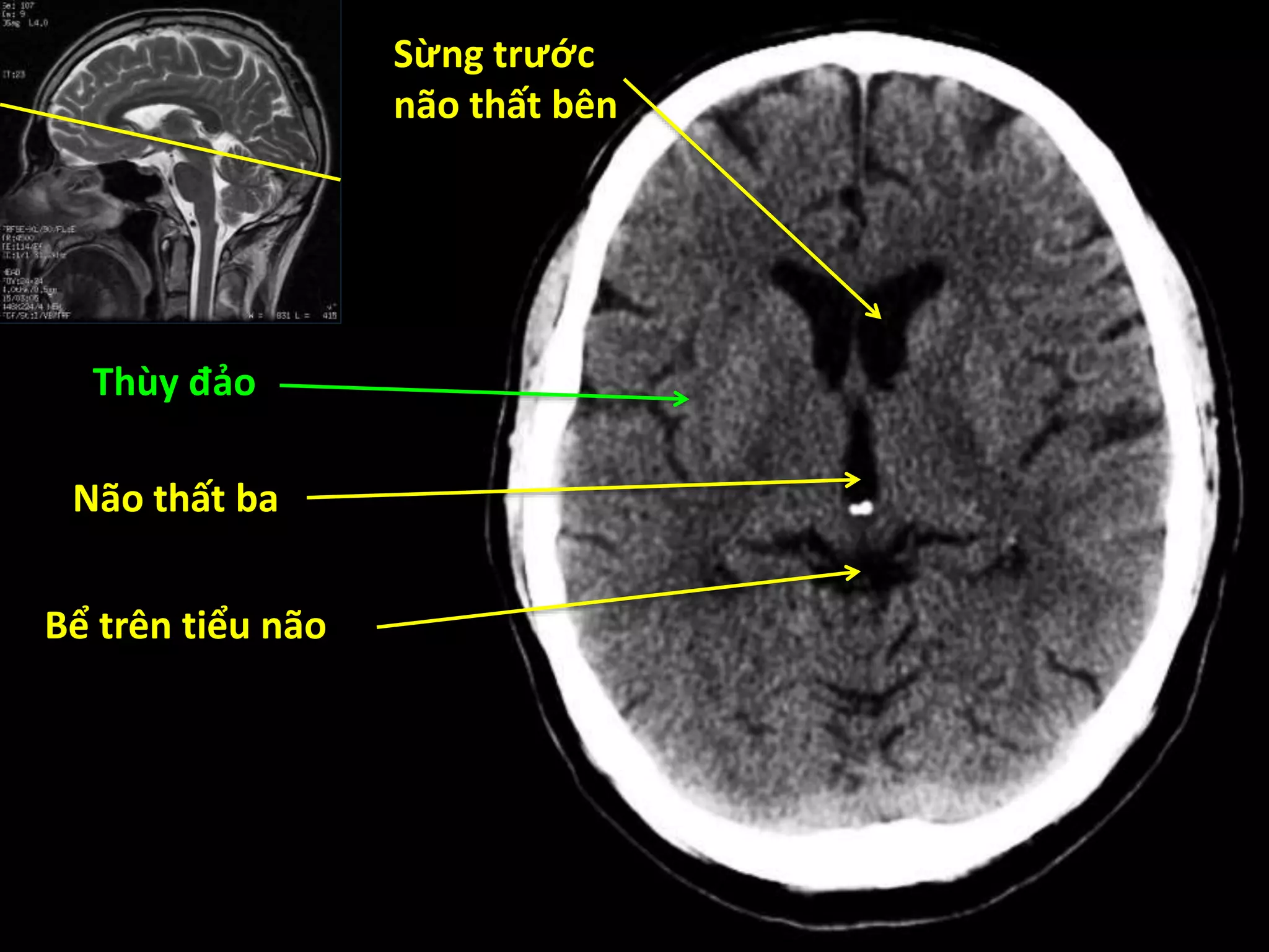 Sừng trước
não thất bên
Thùy đảo
Não thất ba
Bể trên tiểu não
 