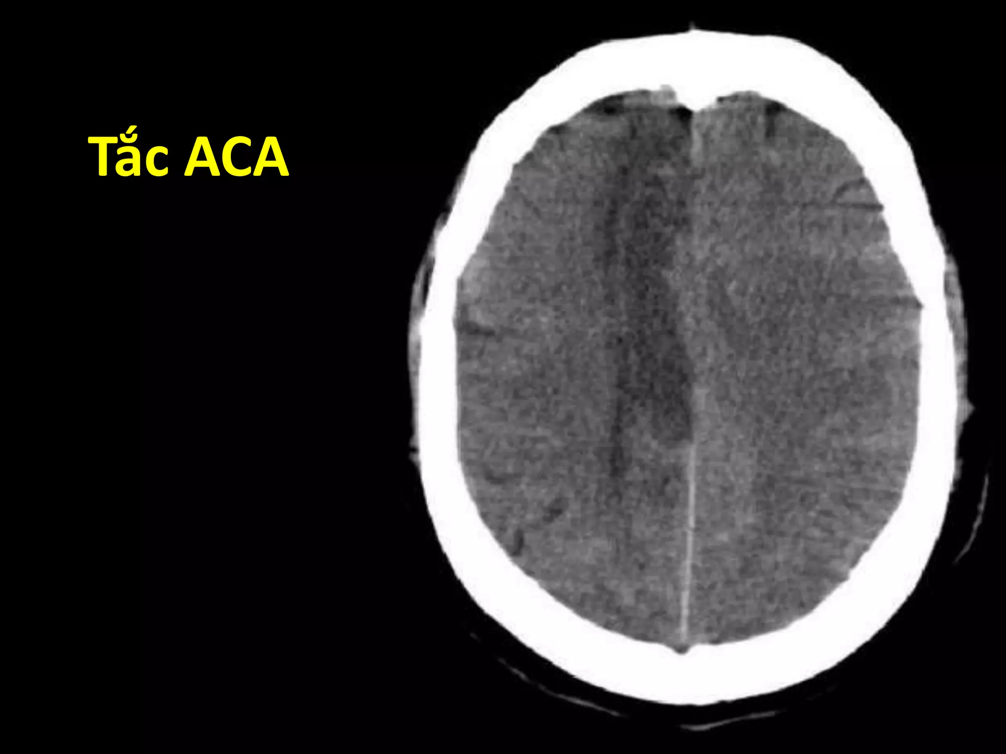 Tắc ACA
 