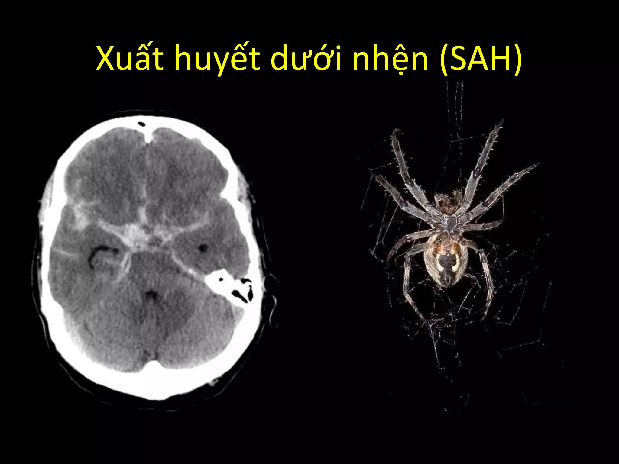 Xuất huyết dưới nhện (SAH)
 