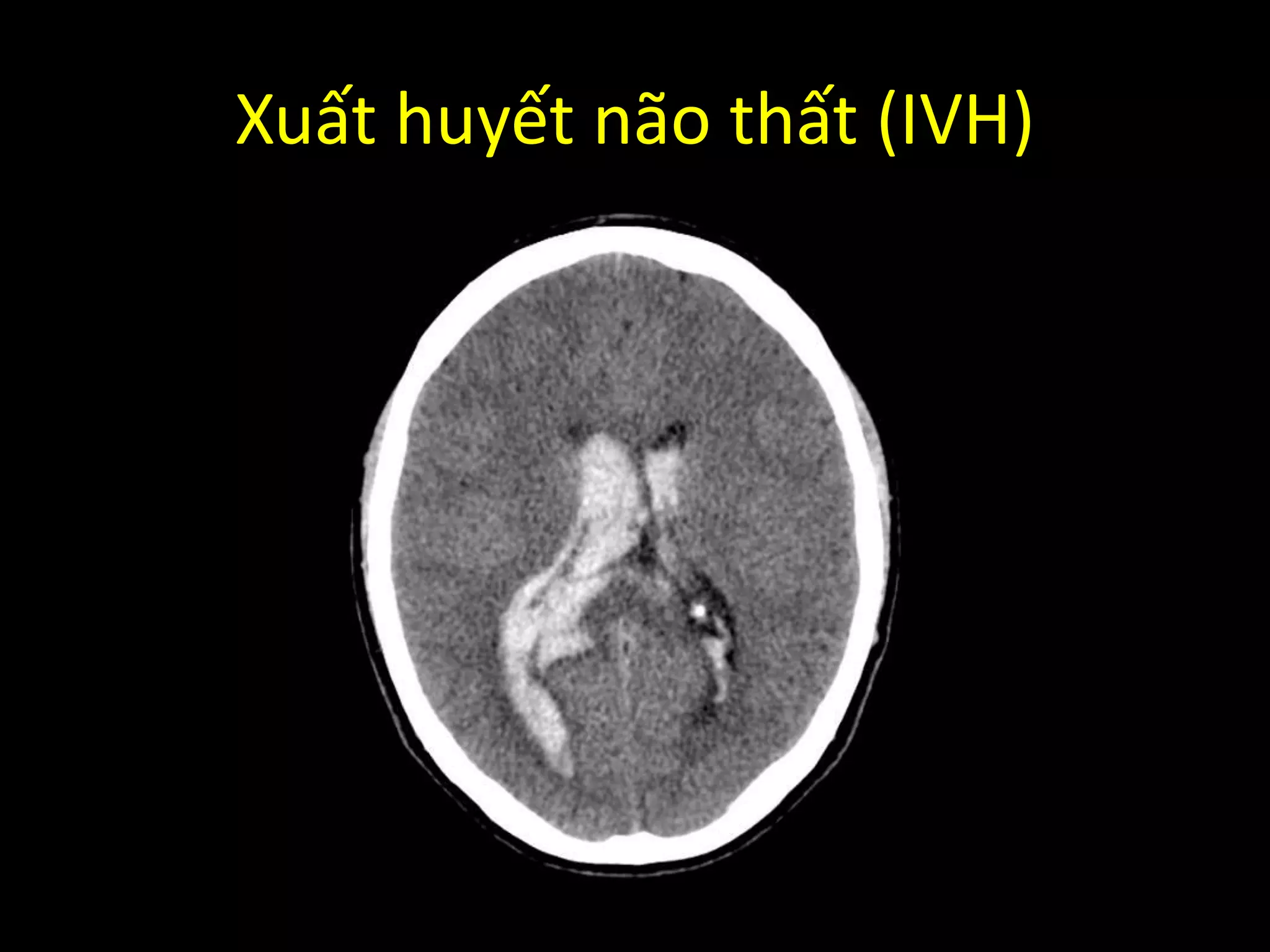 Xuất huyết não thất (IVH)
 