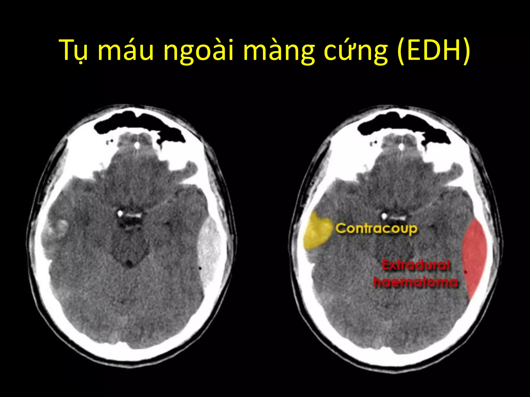Tụ máu ngoài màng cứng (EDH)
 