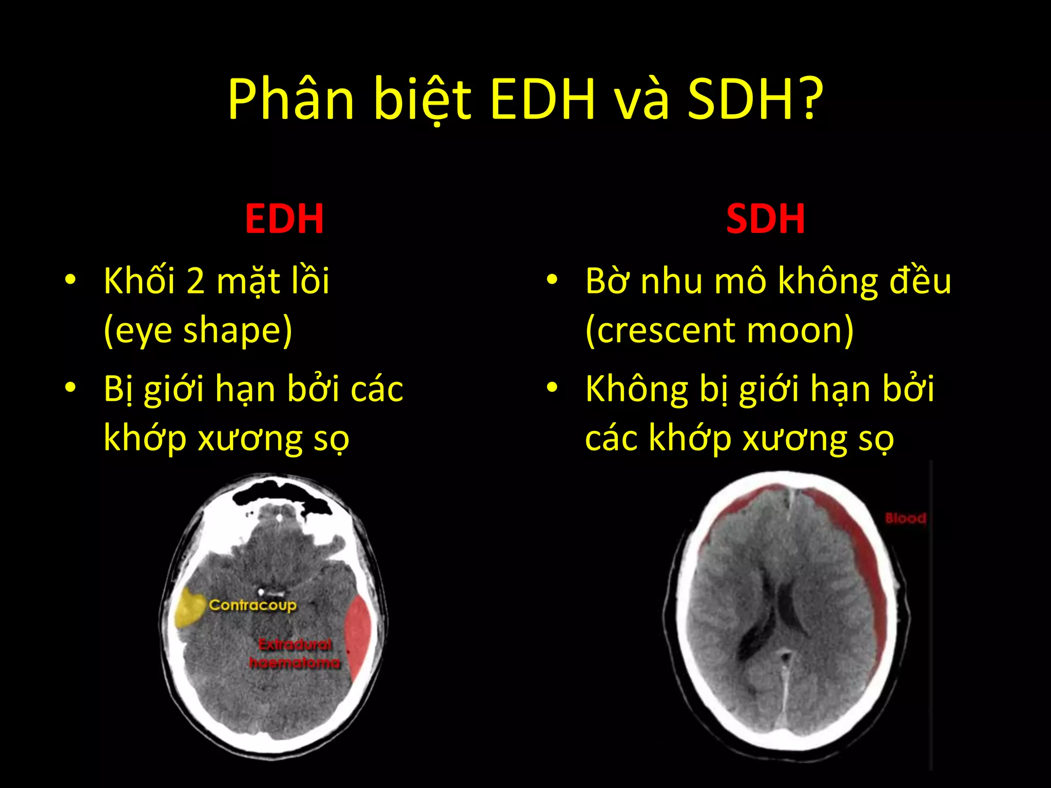 Phân biệt EDH và SDH?
EDH
• Khối 2 mặt lồi
(eye shape)
• Bị giới hạn bởi các
khớp xương sọ
SDH
• Bờ nhu mô không đều
(crescent moon)
• Không bị giới hạn bởi
các khớp xương sọ
 