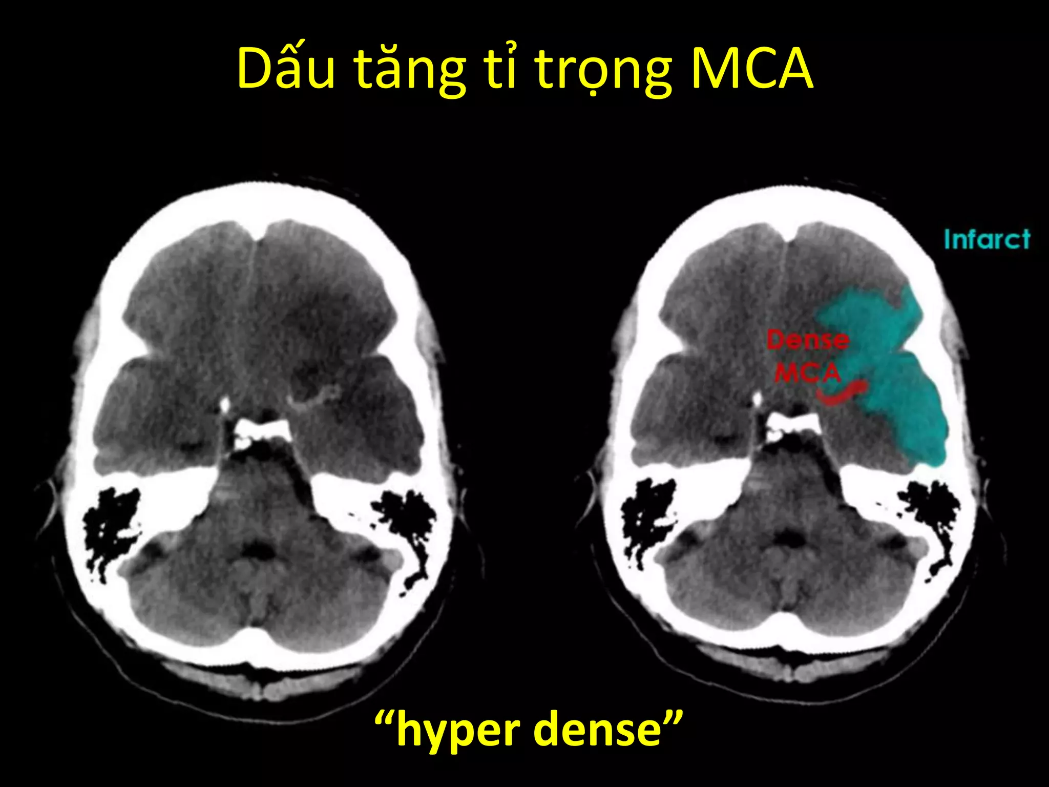 Dấu tăng tỉ trọng MCA
“hyper dense”
 