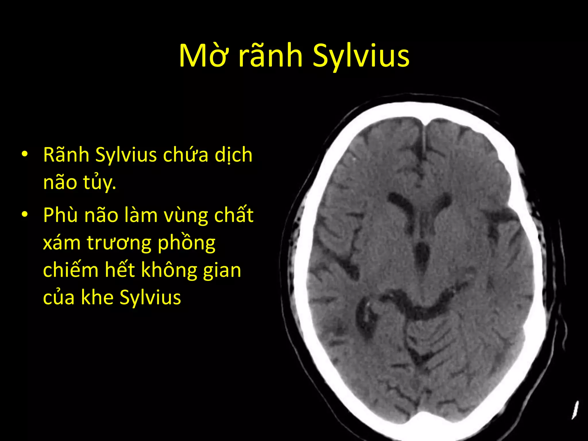 Mờ rãnh Sylvius
• Rãnh Sylvius chứa dịch
não tủy.
• Phù não làm vùng chất
xám trương phồng
chiếm hết không gian
của khe Sylvius
 