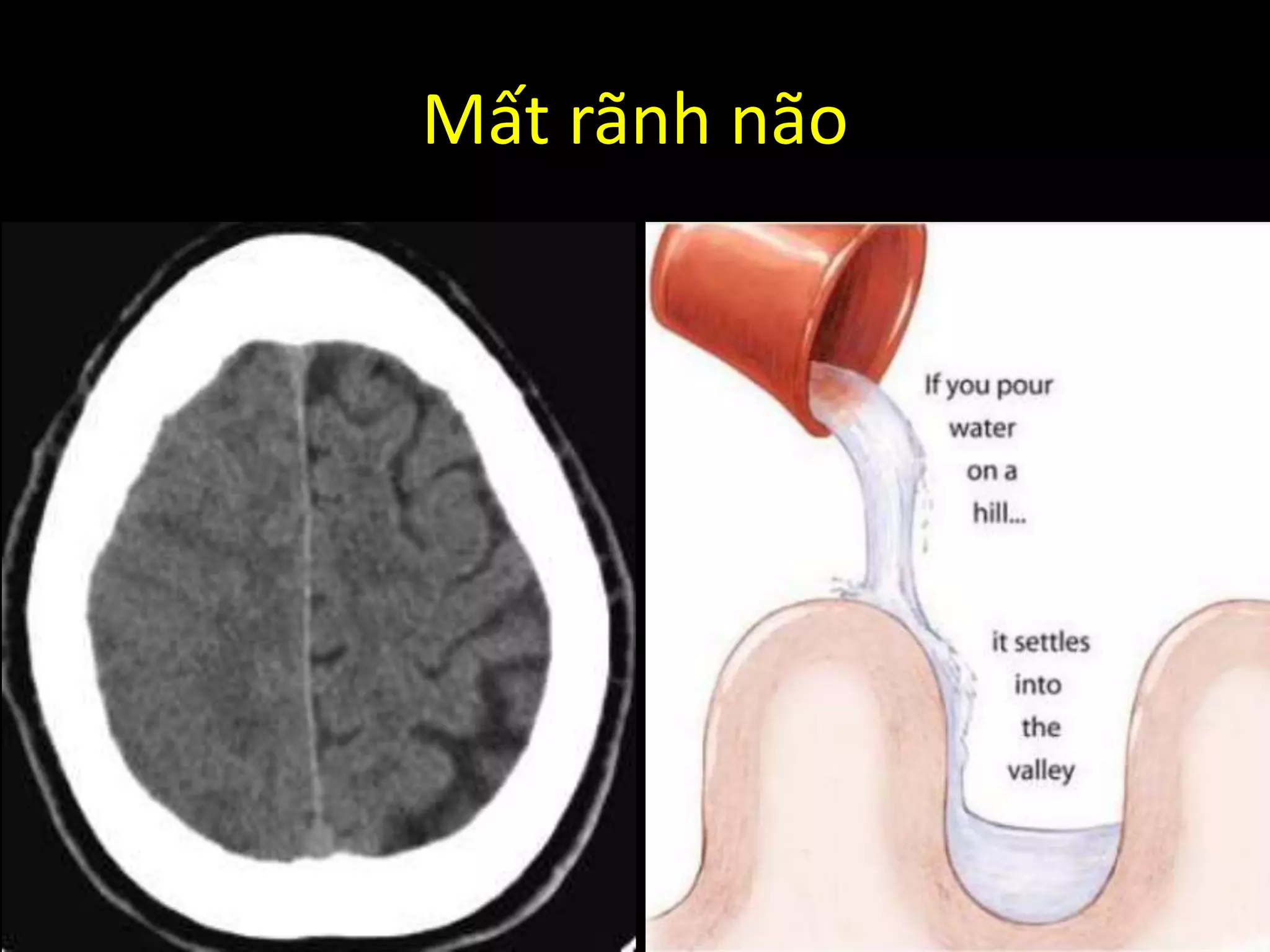 Mất rãnh não
 