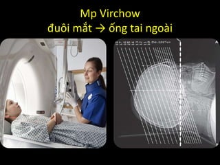 Mp Virchow
đuôi mắt → ống tai ngoài
 