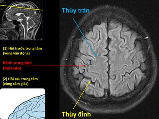 Rãnh trung tâm
(Rolando)
1
2
(1) Hồi trước trung tâm
(vùng vận động)
(2) Hồi sau trung tâm
(vùng cảm giác)
Thùy trán
Thùy đỉnh
 
