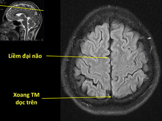 Liềm đại não
Xoang TM
dọc trên
 
