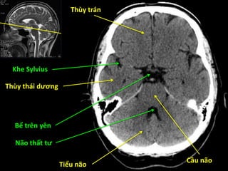 Thùy trán
Thùy thái dương
Tiểu não
Cầu não
Não thất tư
Bể trên yên
Khe Sylvius
 