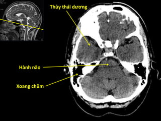 Thùy thái dương
Hành não
Xoang chũm
 