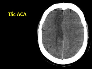Tắc ACA
 