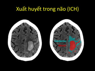 Xuất huyết trong não (ICH)
 