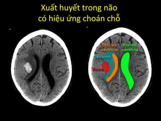 Xuất huyết trong não
có hiệu ứng choán chỗ
 