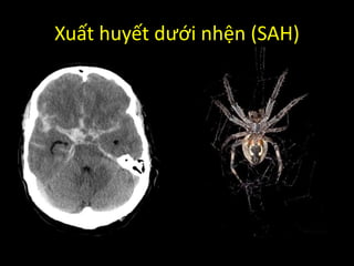 Xuất huyết dưới nhện (SAH)
 