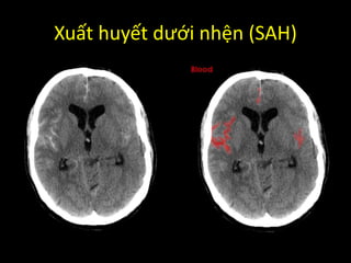 Xuất huyết dưới nhện (SAH)
 
