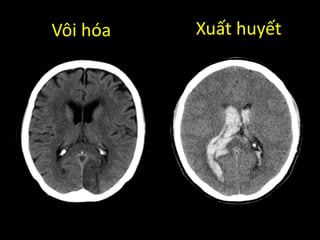 Vôi hóa Xuất huyết
 