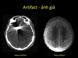 Artifact - ảnh giả
Metal artifact Ring artifact
 
