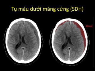 Tụ máu dưới màng cứng (SDH)
 