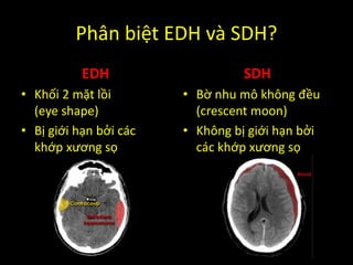 Phân biệt EDH và SDH?
EDH
• Khối 2 mặt lồi
(eye shape)
• Bị giới hạn bởi các
khớp xương sọ
SDH
• Bờ nhu mô không đều
(crescent moon)
• Không bị giới hạn bởi
các khớp xương sọ
 
