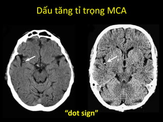 Dấu tăng tỉ trọng MCA
“dot sign”
 