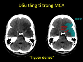 Dấu tăng tỉ trọng MCA
“hyper dense”
 