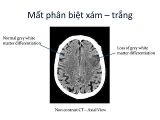 Mất phân biệt xám – trắng
 