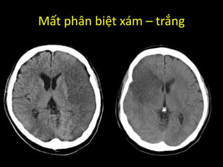 Mất phân biệt xám – trắng
 