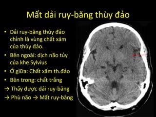 Mất dải ruy-băng thùy đảo
• Dải ruy-băng thùy đảo
chỉnh là vùng chất xám
của thùy đảo.
• Bên ngoài: dịch não tủy
của khe Sylvius
• Ở giữa: Chất xấm th.đảo
• Bên trong: chất trắng
→ Thấy được dải ruy-băng
→ Phù não → Mất ruy-băng
 