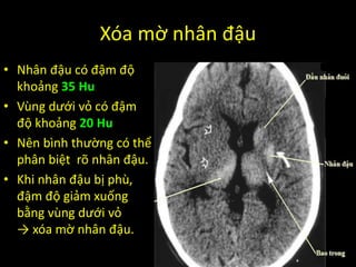 Xóa mờ nhân đậu
• Nhân đậu có đậm độ
khoảng 35 Hu
• Vùng dưới vỏ có đậm
độ khoảng 20 Hu
• Nên bình thường có thể
phân biệt rõ nhân đậu.
• Khi nhân đậu bị phù,
đậm độ giảm xuống
bằng vùng dưới vỏ
→ xóa mờ nhân đậu.
 