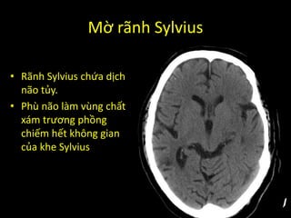Mờ rãnh Sylvius
• Rãnh Sylvius chứa dịch
não tủy.
• Phù não làm vùng chất
xám trương phồng
chiếm hết không gian
của khe Sylvius
 