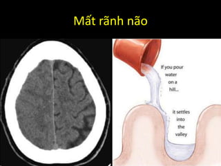 Mất rãnh não
 