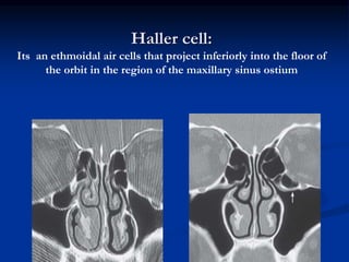 CT Scan Of Nose And PNS PPT CT Scan Of Nose And PNS PPT