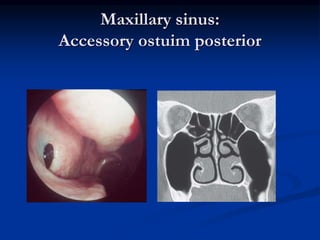 Accessory Ostium CT scan of nose and PNS | PPT
