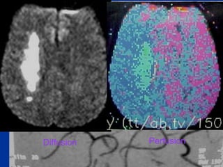 Diffusion Perfusion
 