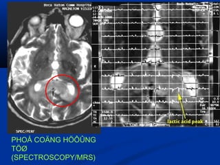 Choline vaø lactic acidPHOÅ COÄNG HÖÔÛNG
TÖØ
(SPECTROSCOPY/MRS)
 