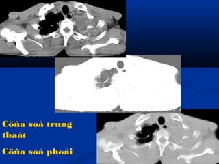 Cöûa soå trung
thaát
Cöûa soå phoåi
 