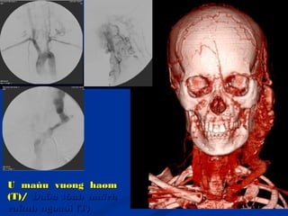 U maùu vuøng haømU maùu vuøng haøm
(T)/(T)/ Daõn tónh maïchDaõn tónh maïch
caûnh ngoaøi (T)caûnh ngoaøi (T)
 