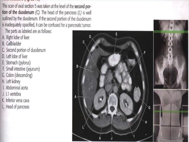 CT scan ABDOMEN Explained توضیحات سی تی اسکن شکم ولگن.ppt