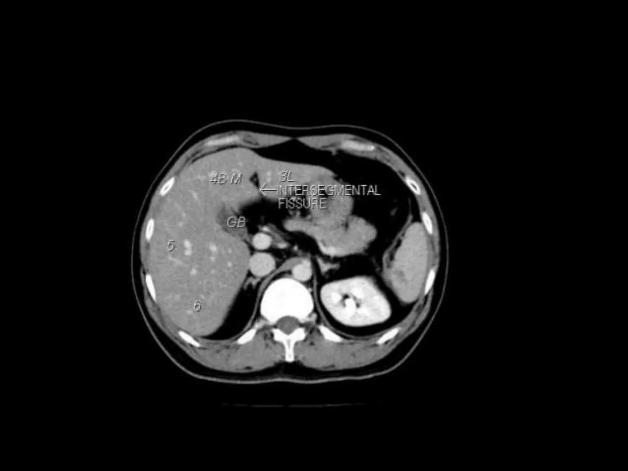 CT ABDOMEN ANATOMY | PPTX