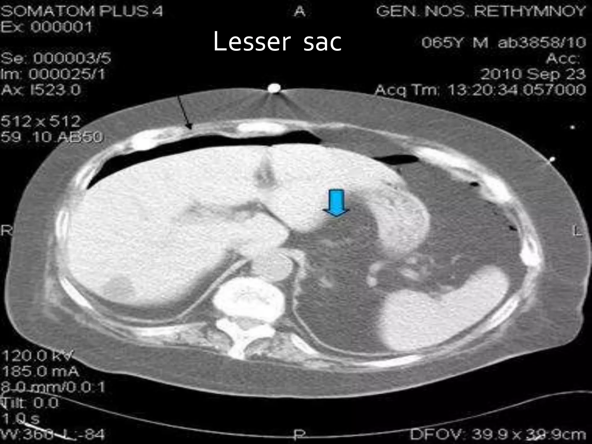 Lesser Sac Collection CT ABDOMEN ANATOMY | PPTX